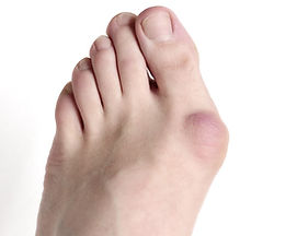 bunion_1280.jpg